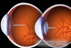 cataract Urdu Meaning